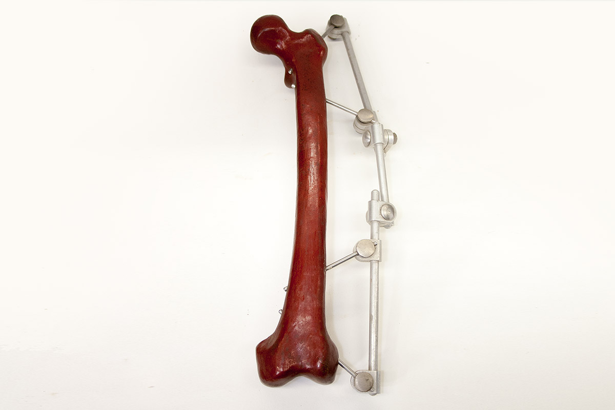 Femur Bone with common fracture sites noted